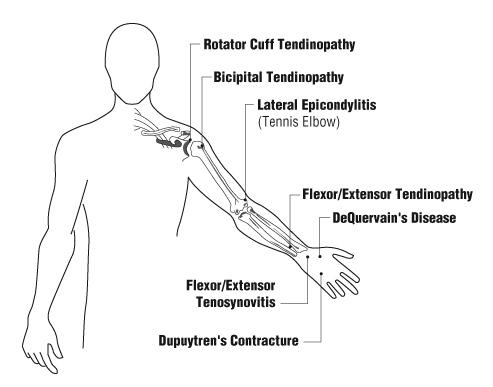 Common sites for tendon disorders