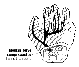 Figure 7B - Wrist/ signs of Carpal Tunnel Syndrome